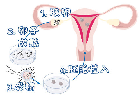 男性不育案例